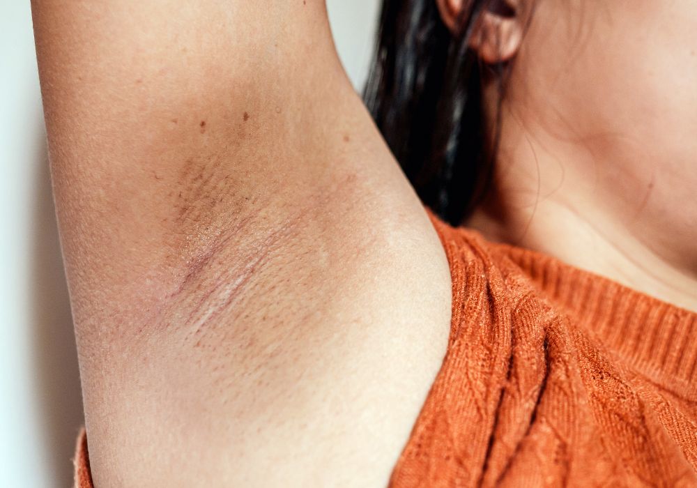 Clareamento de Axilas Melhores Tratamentos e Preço Médio