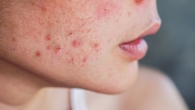 Melhor Produto para Tratar Acne e Espinhas Top 6 do Momento