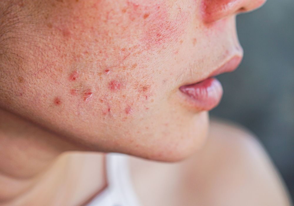 Melhor Produto para Tratar Acne e Espinhas Top 6 do Momento