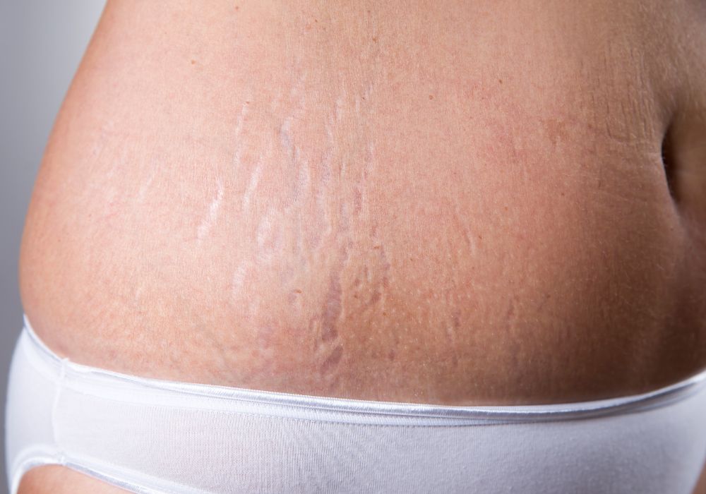 6 Melhores Cremes com Retinol para Estrias Profundas 6 Melhores Cremes com Retinol para Estrias Profundas